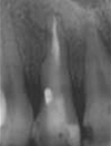 Trattamento endodontico laser - Dopo
