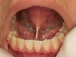 Frenulectomia orale - Prima della cura