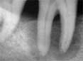 Parodontite radiografia dopo trattamento con laser