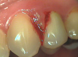 Parodontite sanguinamento