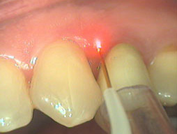 Parodontite trattata laser