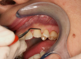 Diagnosi parodontite
