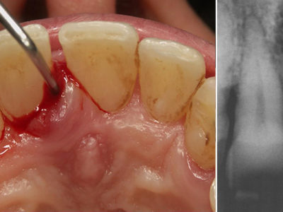 Ascesso Parodontale - Cura
