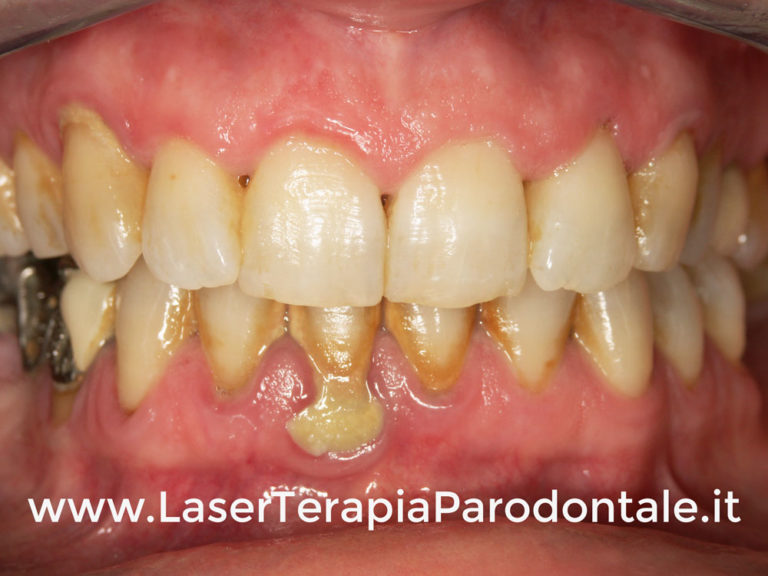 Dopo Quanto Cadono I Denti Con La Parodontite La parodontite più frequente? La parodontite cronica - Centro