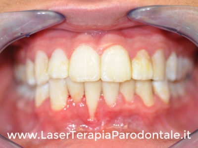 Parodontite: sintomi