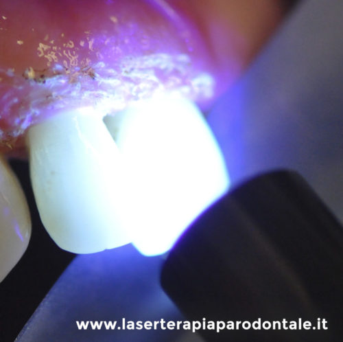 Azione decontaminante con Laser